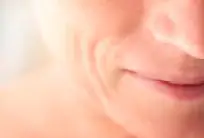 Restylane® marionette lines treatment