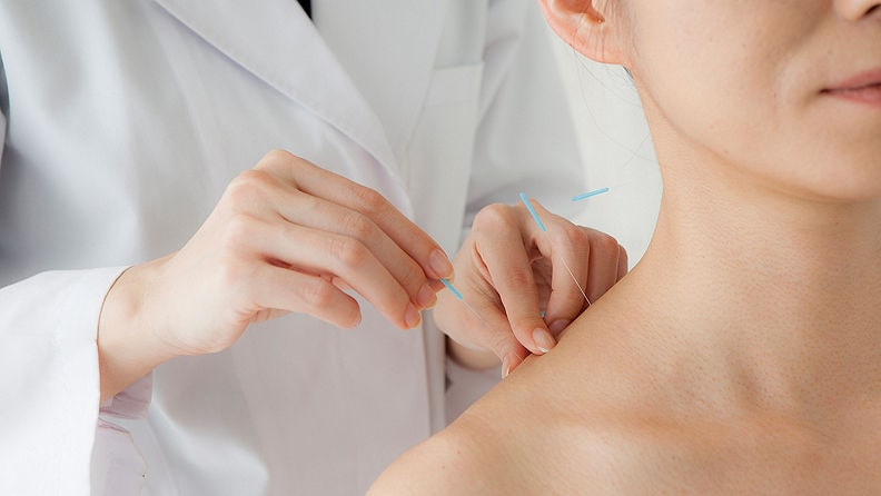 Acupuncture