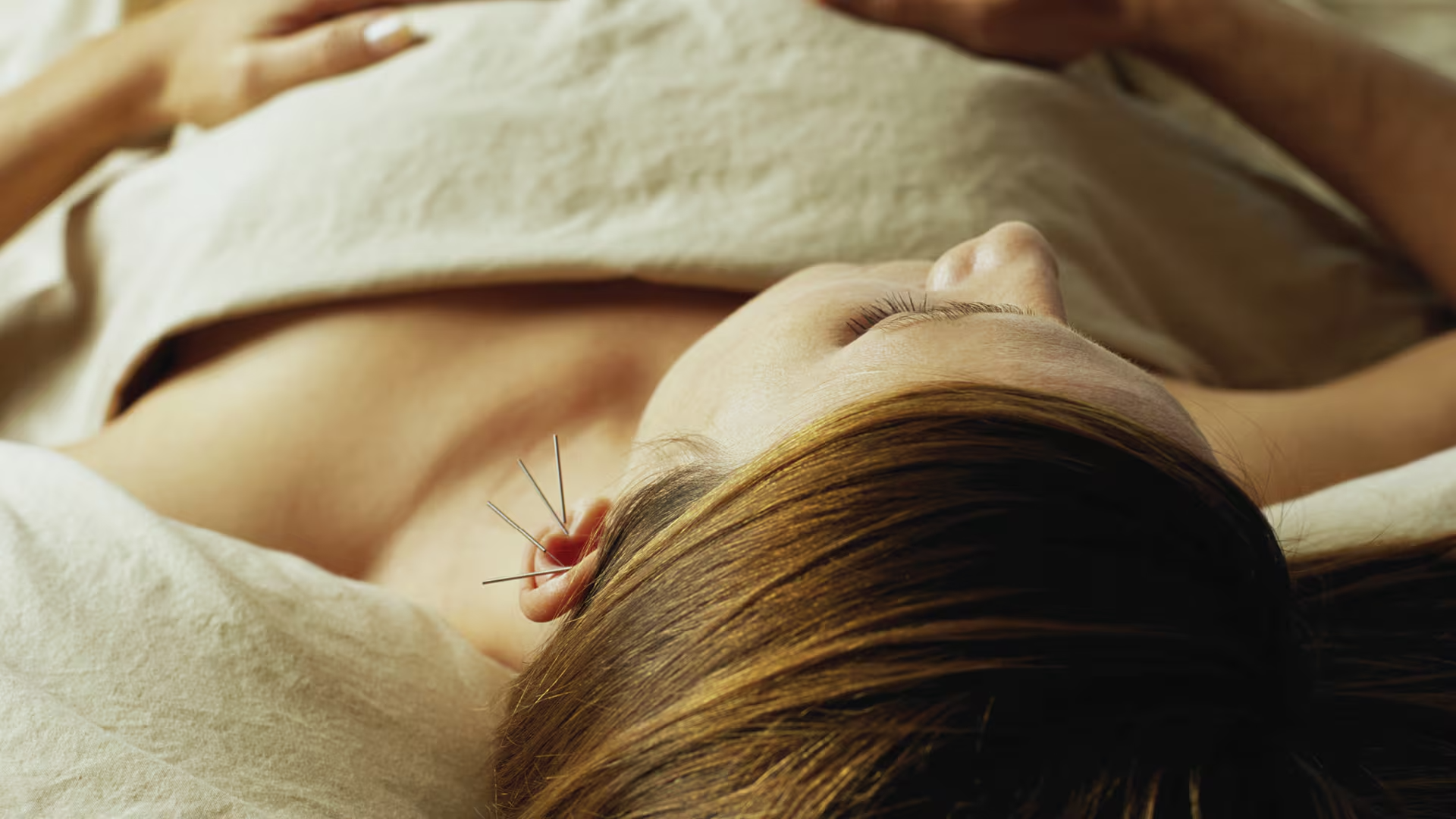 Traditional chinese acupuncture – 1 session