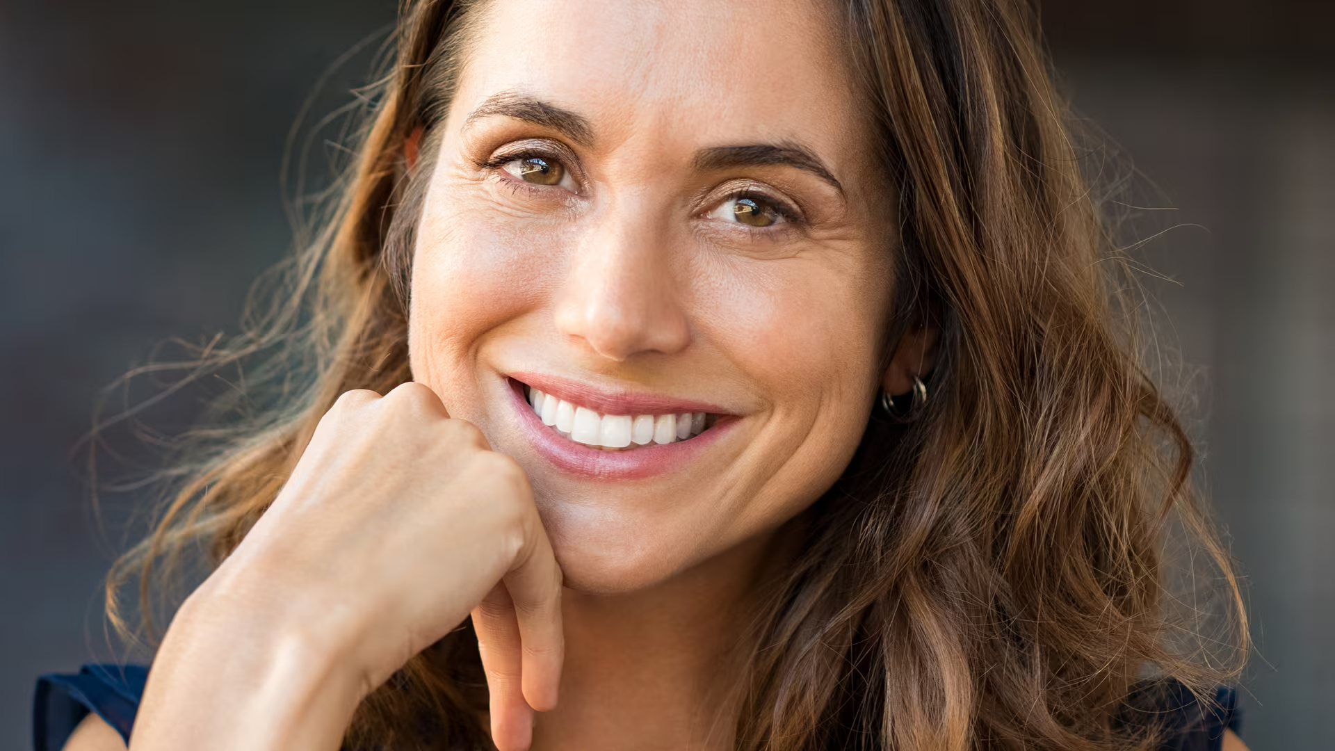 Restylane® smile lines treatment