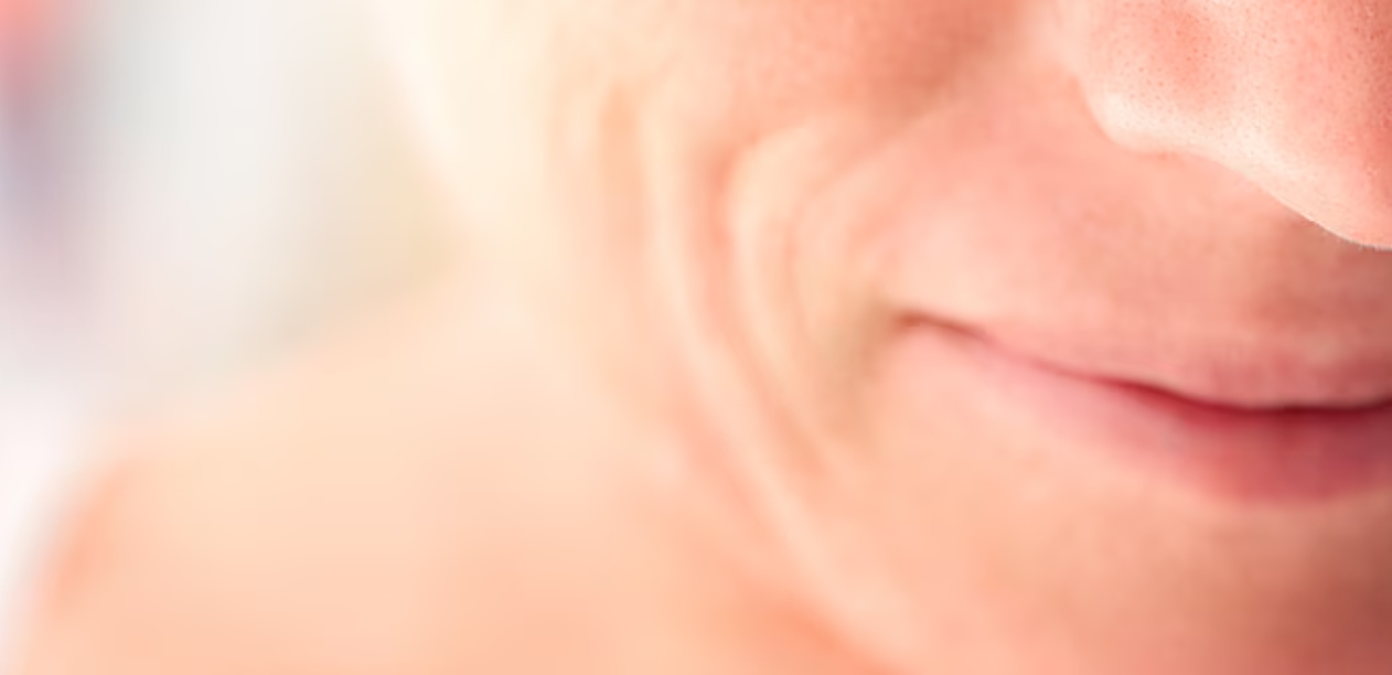 Restylane® marionette lines treatment