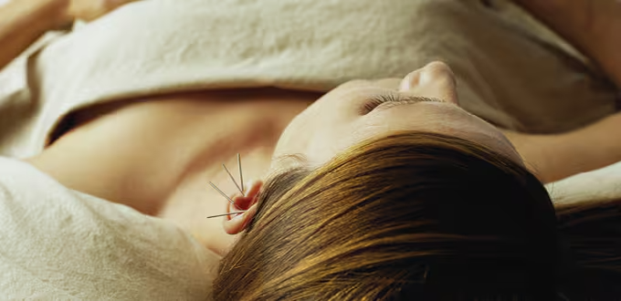Traditional chinese acupuncture – 1 session