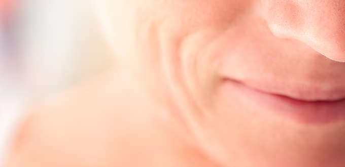 Restylane® marionette lines treatment